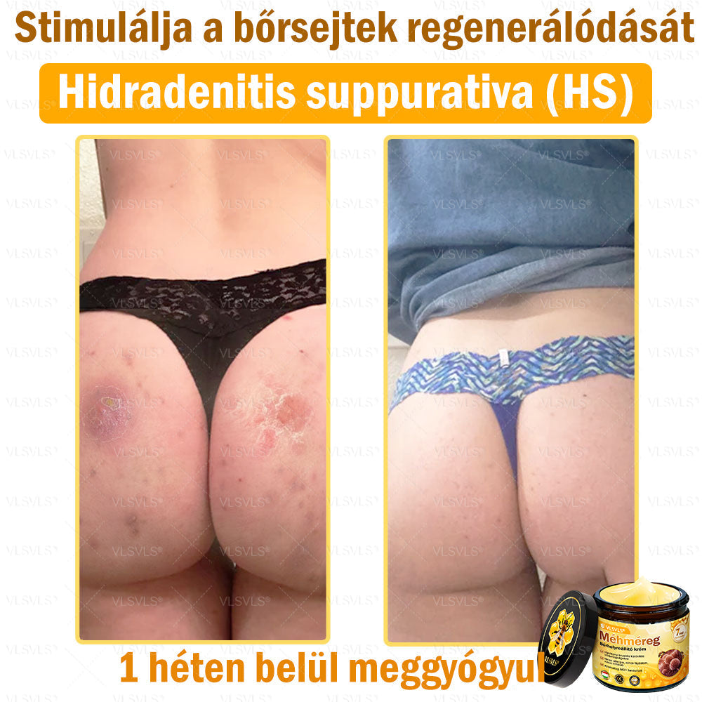 💪💪💪VLSVLS® Méhméreg Bőrhelyreállító Krém (👨⚕CE jóváhagyott)👍✅