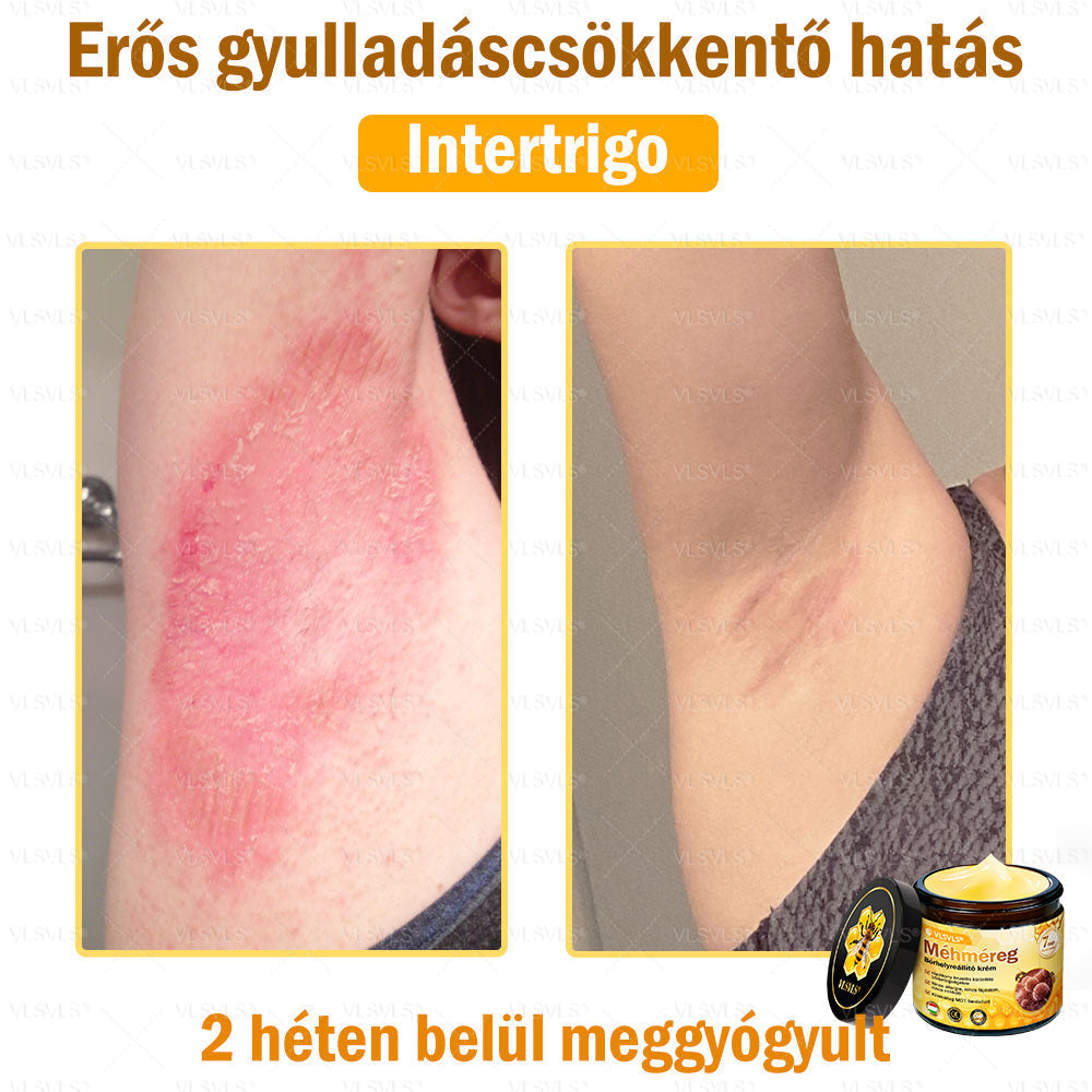 💪💪💪VLSVLS® Méhméreg Bőrhelyreállító Krém (👨⚕CE jóváhagyott)👍✅