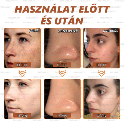 🌿FRISSARC™ fehérítő és folteltávolító arcmaszk – Természetes összetevők tartósan eltüntetik a foltokat, szeplőket és napfoltokat.