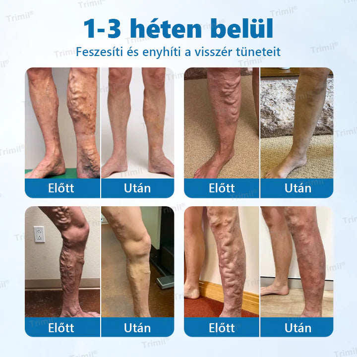 🟢Trimil® VeinGuard Gyógynövényes Spray - ✅ Klinikailag bizonyított, hogy mindössze 7 nap alatt megszünteti a visszereket!