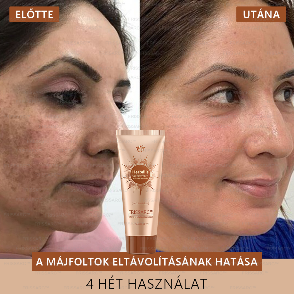 🌿FRISSARC™ fehérítő és folteltávolító arcmaszk – Természetes összetevők tartósan eltüntetik a foltokat, szeplőket és napfoltokat.