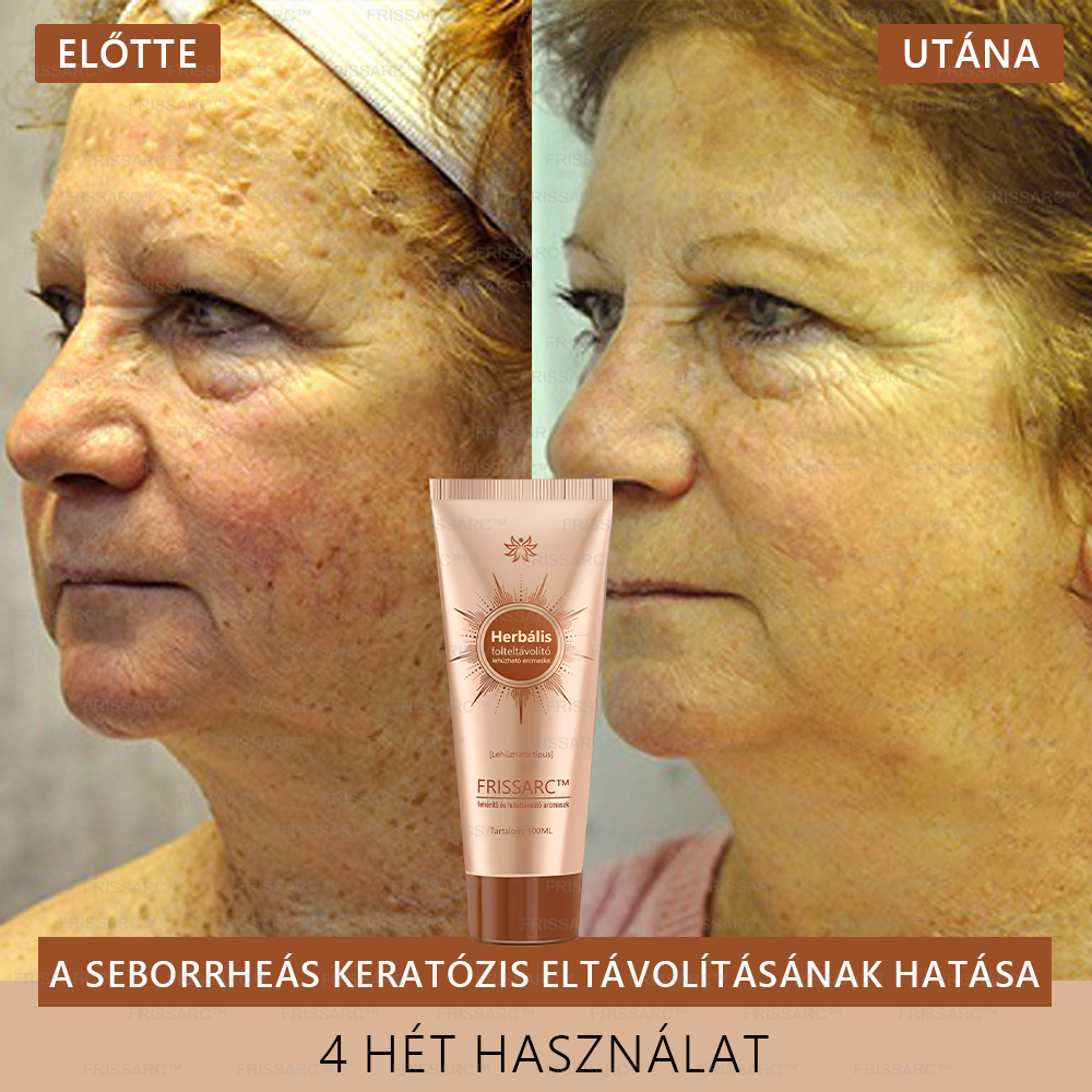 🌿FRISSARC™ fehérítő és folteltávolító arcmaszk – Természetes összetevők tartósan eltüntetik a foltokat, szeplőket és napfoltokat.
